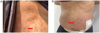 Severe allergic rash induced by icodextrin: case report and literature review